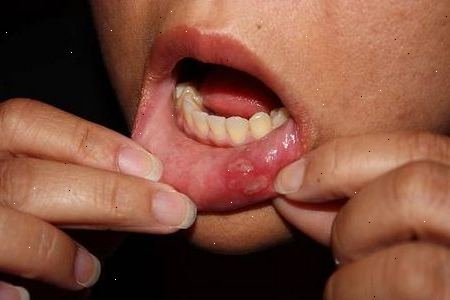 Hvordan å behandle feber blemmer i småbarn. Dessverre kan munnherpes inngås av småbarn i tillegg.