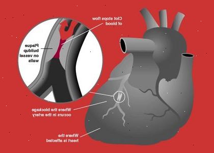 Hvordan å gjenkjenne stille hjerteinfarkt symptomer. Brystsmerter.