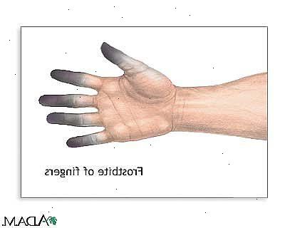 Prikking fingre forårsake ubehag. Du må kanskje se legen din dersom du føler pins og nåler sensasjon.