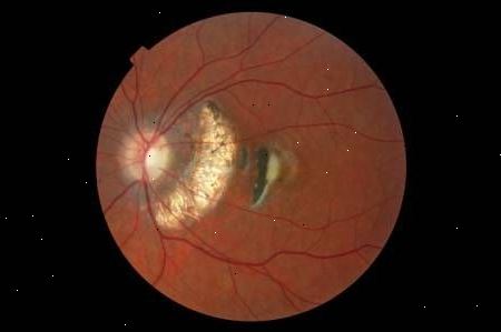 Hvordan forberede og gjenopprette fra kosmetisk øyelokk kirurgi