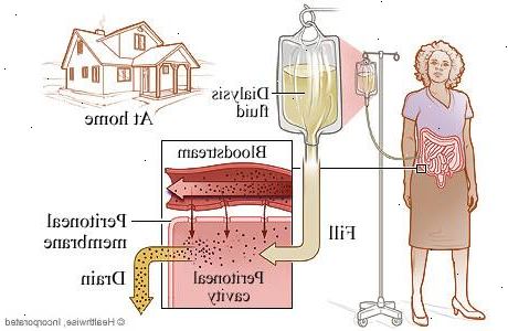 Hvordan å utføre peritonealdialyse hjemme. I dag praktisering av peritonealdialyse kommer i to typer.